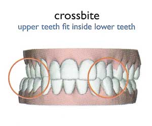 crossbite palatal expanders expander correct teeth braces surgery jaw invisalign crossbites rapid services orthodontic corrected fix widen dental veneers smile