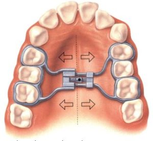 Palatal Expanders to Correct Crossbite