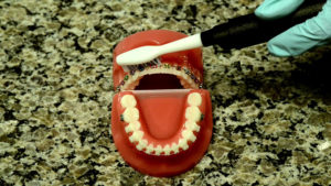 Brushing and Flossing with Braces