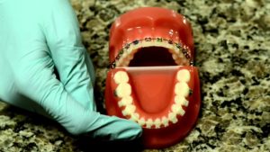 Life with Braces