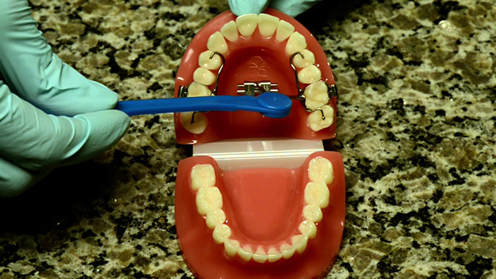 RPE or Rapid Palatal Expander