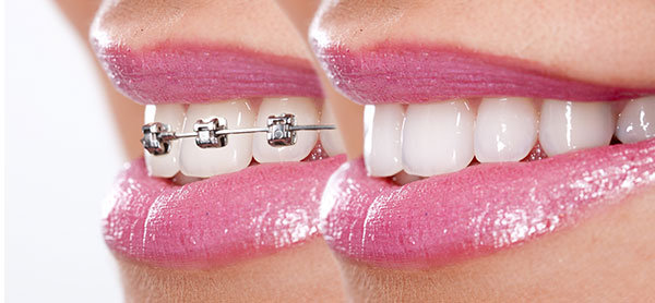 How Braces Work in Five Simple Steps