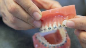 Loose brackets or bands